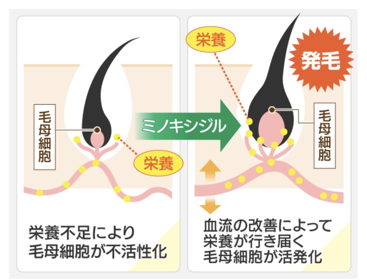 ミノキシジル